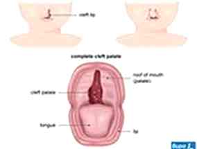 GELİŞİMSEL DİL VE KONUŞMA BOZUKLUĞU